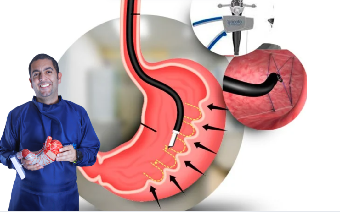 Manga Gástrica Endoscópica: La solución eficaz para perder peso sin cirugía